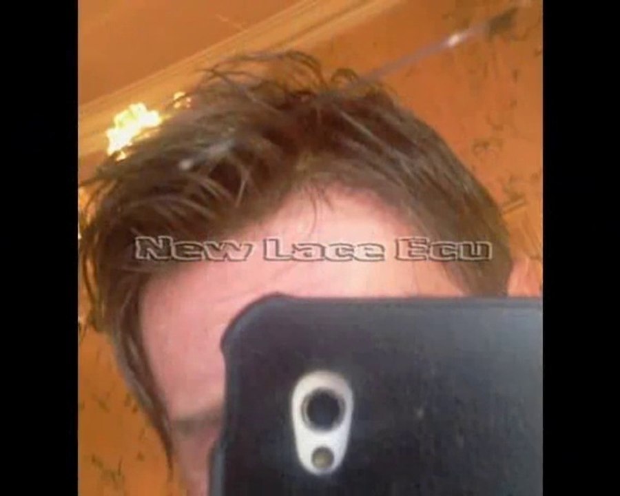 Hair replacement systems-sistema capilar masculino- infoltimento non chirurgico uomo.