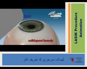 PRK-Lasik-Femto Procedures