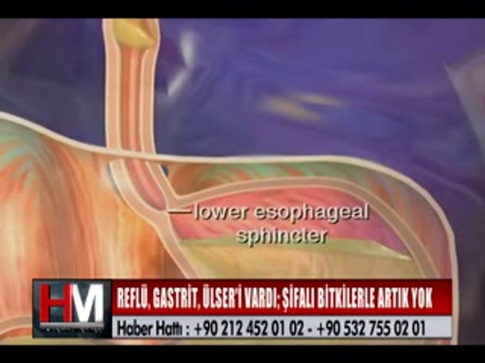 REFLÜYE, GASTRİTE VE ÜLSERE KESİN ÇÖZÜM!