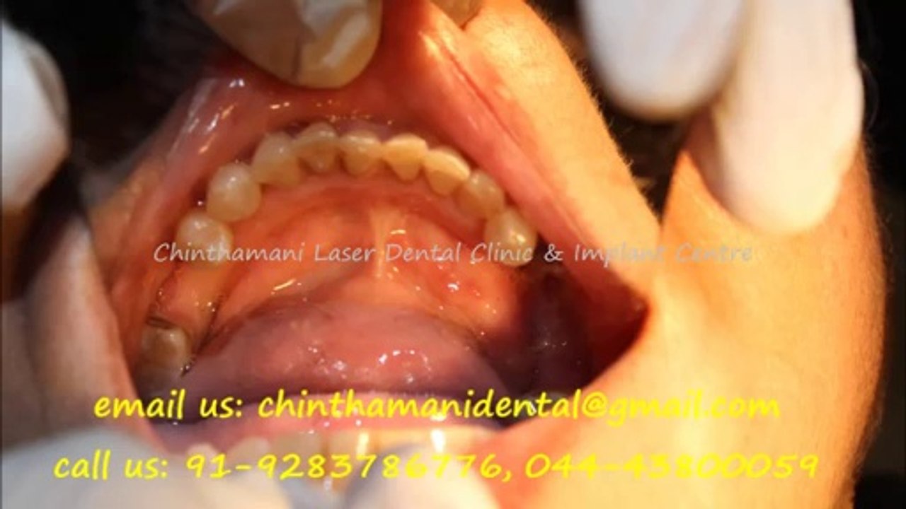 AFFORDABLE DENTAL IMPLANTS IN CHENNAI