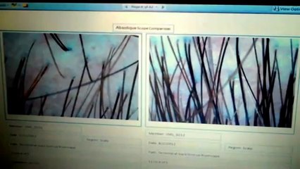 Hair Loss Treatments By Absolique Hair Health Clinic