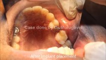 DENTAL IMPLANTS IN INDIA - PERMANENT TEETH IN 1 DAY