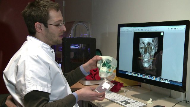 Impresora 3D mejora cirugías reconstructivas