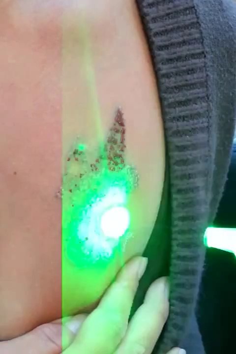 Remove Body Tattoo
