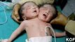 Rare Set Of Conjoined Twins Born In India