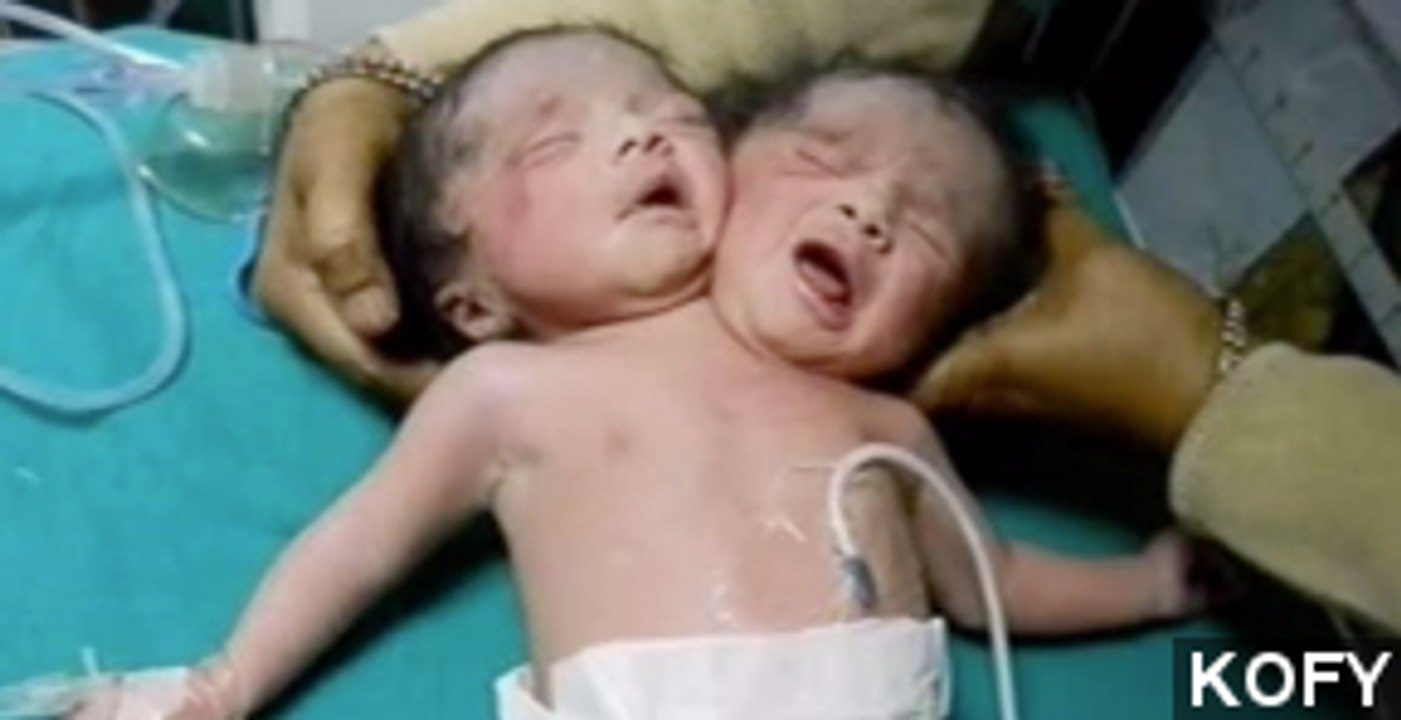 Rare Set Of Conjoined Twins Born In India