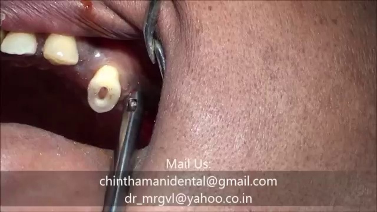 Flapless BCS Implant placement with HANDLE