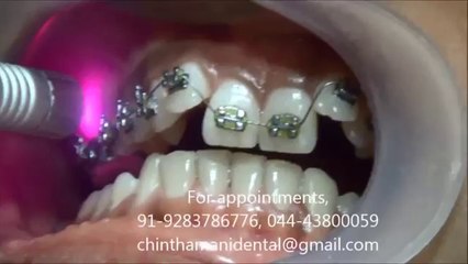 BIOSTIMULATION WITH DIODE LASER FOR ORTHODONTIC PATIENT