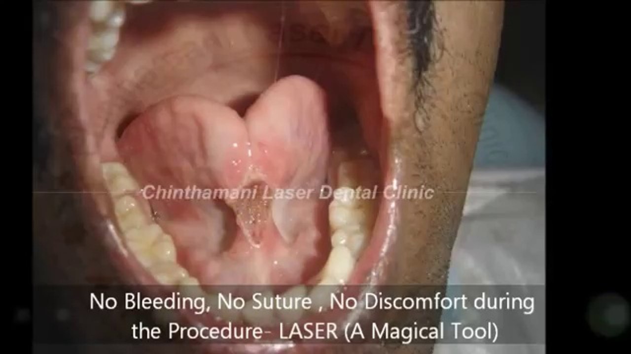 Laser Treatment For Tongue Tie in Chennai,India.