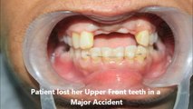 Upper Front teeth lost in Accident Replaced by Dental Implants (BCS Implants)