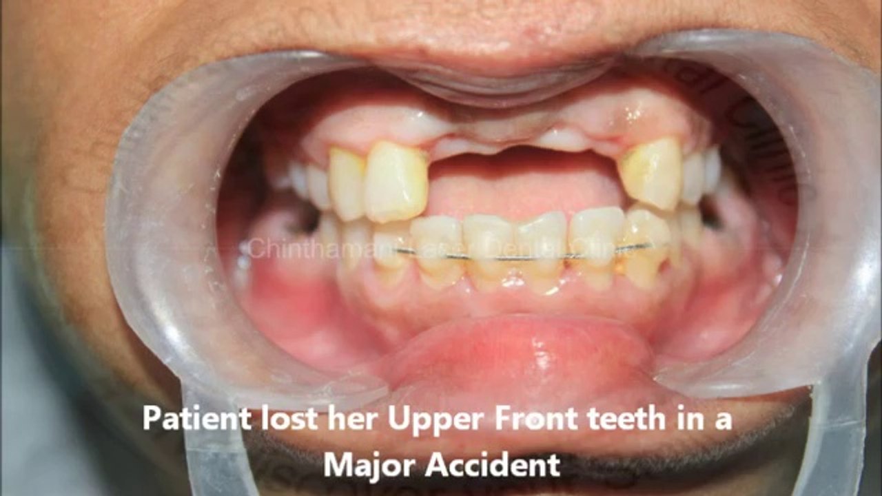 Upper Front teeth lost in Accident Replaced by Dental Implants (BCS Implants)