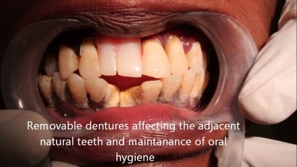 Severe Periodontitis and poor oral hygiene