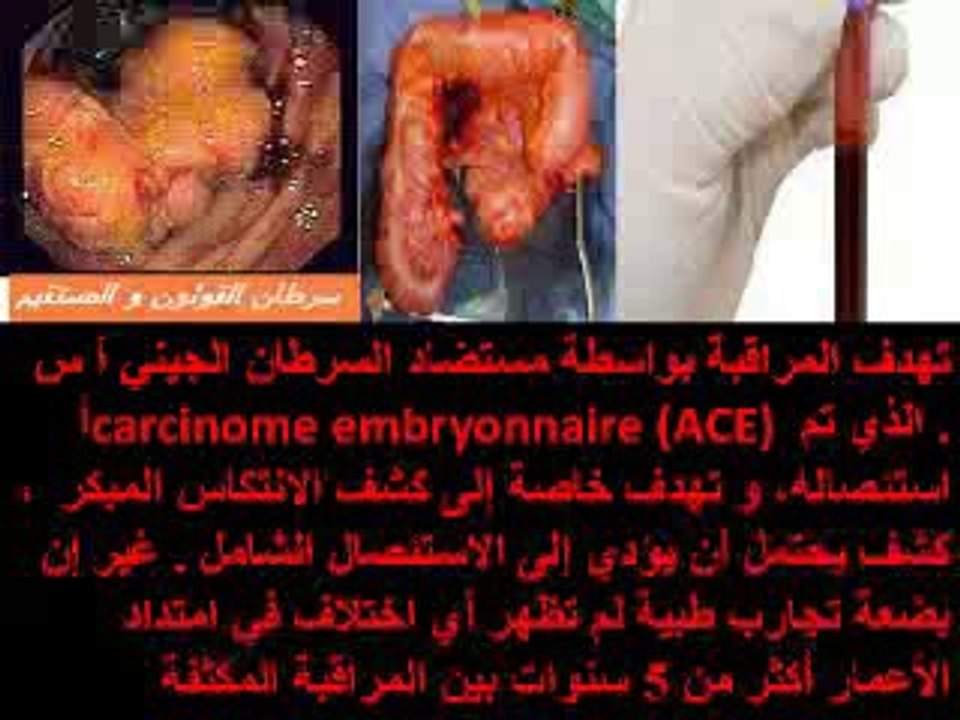 Les marqueurs sanguins tumoraux en cancérologie digestive