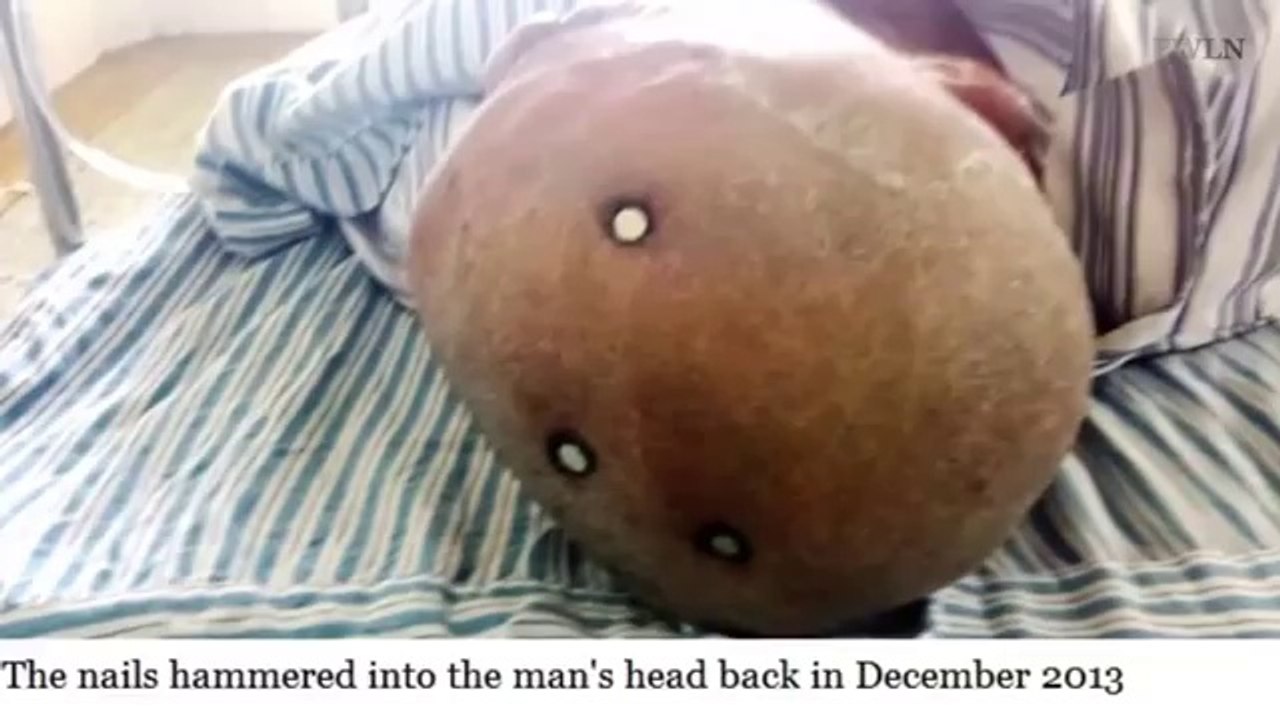 Hammer head lark: Chinese man has three four-inch nails removed from his skull