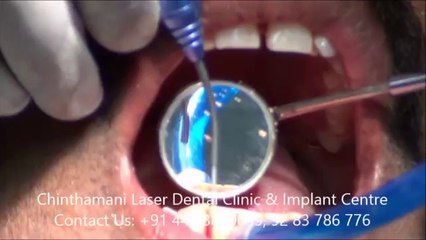 Soft tissue Laser Training Video By Dr Murugavel Part 2