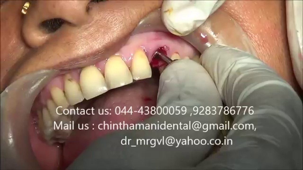 Upper canine rootstump extraction and BCS dental implant in India video part 2