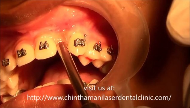 UPPER FRONT TEETH REPLACEMENT WITH AFFORDABLE DENTAL IMPLANTS
