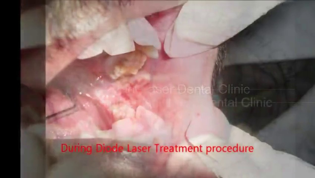Laser Treatment for a Patient with Oral Sub-mucous Fibrosis