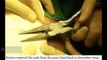 Hammer head lark_ Chinese man has three four-inch nails removed from his
