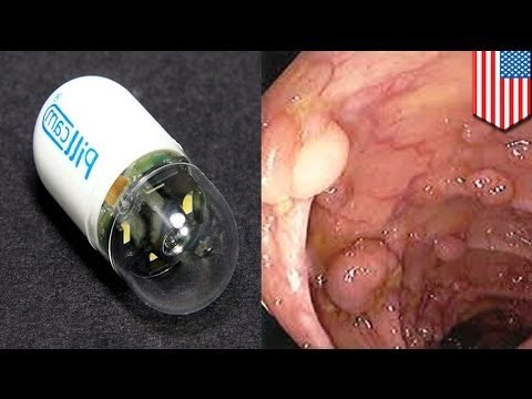 FDA approves swallowable Pillcam to detect colon cancer