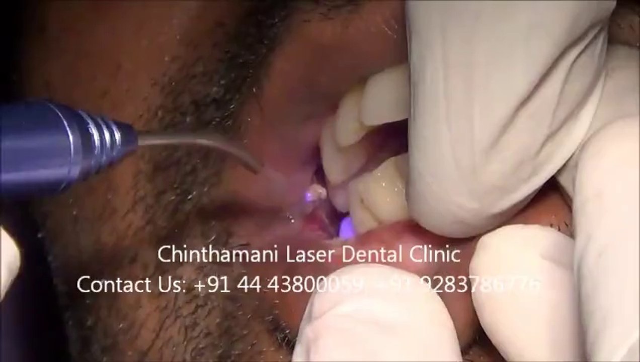 Laser Treatment (Video) for Oral submucous Fibrosis Part -2