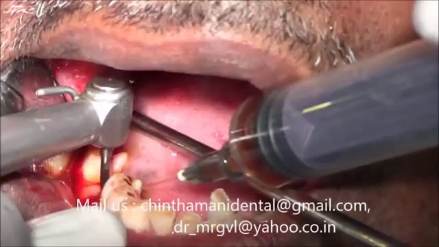Painless extraction of molar rootstumps and immediate implants in India video part 1