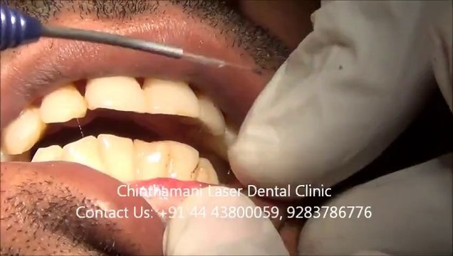 Laser Treatment (Video) for Oral submucous Fibrosis Part -3