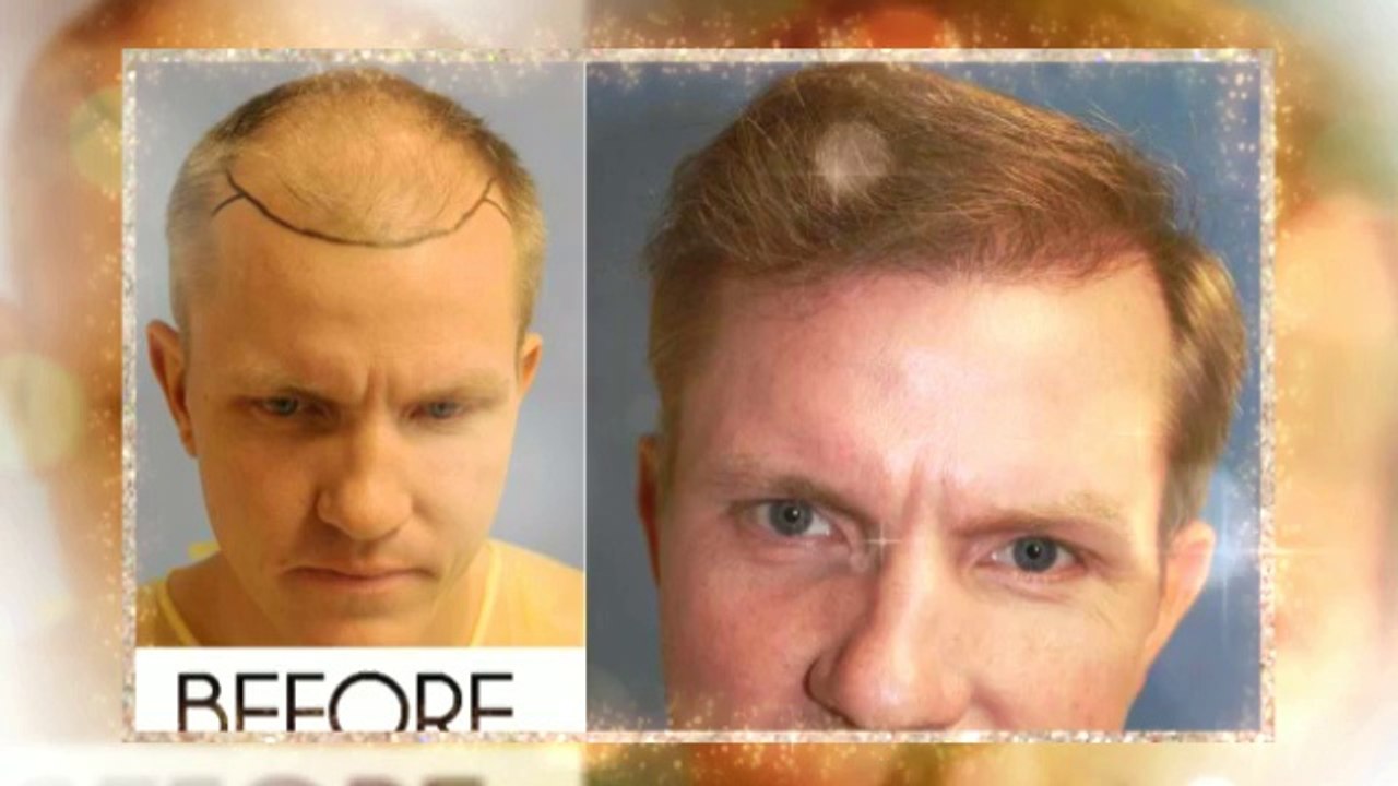 Find out Natural Methods To eliminate Baldness