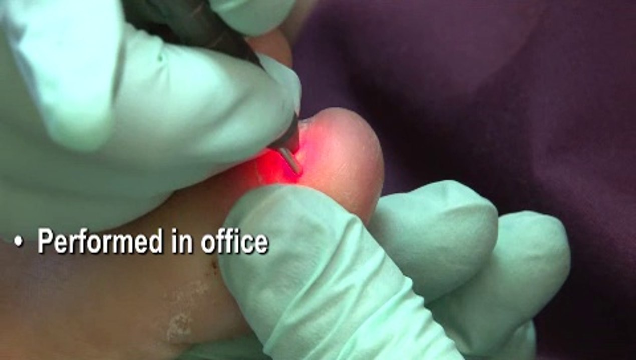 Podiatrist in Atlanta, Marietta and Fulton County, GA - Laser Fungal Toenail Therapy