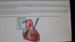 New Heart Glue For PFO ASD Cardiomyopathy Defects