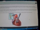 New Heart Glue For PFO ASD Cardiomyopathy Defects
