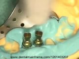 Crowns for Dental Implants being made and placed .