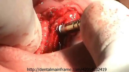 Bone Expansion in Dental Implantology  spanish video source