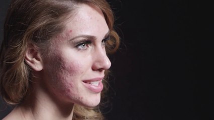 Model without makeup : acne, pimples and skin disease