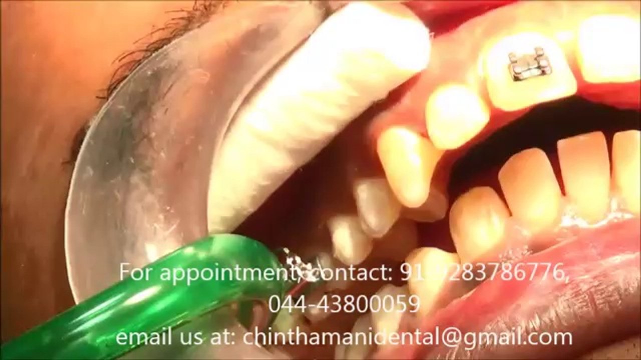 BRACES TREATMENT IN INDIA