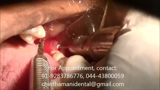 PAINLESS REMOVAL OF HORIZONTALLY IMPACTED WISDOM TOOTH