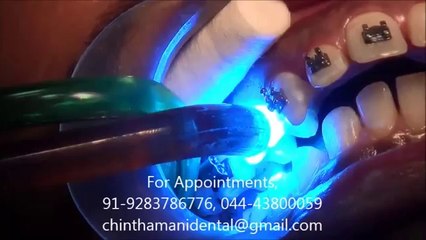 BRACES TREATMENT IN INDIA - PART 2