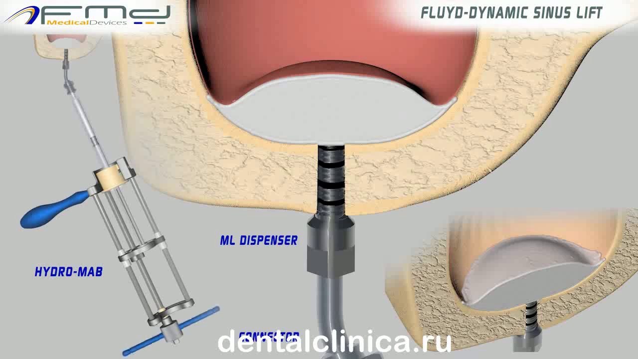 Лечение зубов красивая улыбка коронка циркониевая металлокерамика приятные цены протезирование имплант СГС с абатмантом экспересс терапия