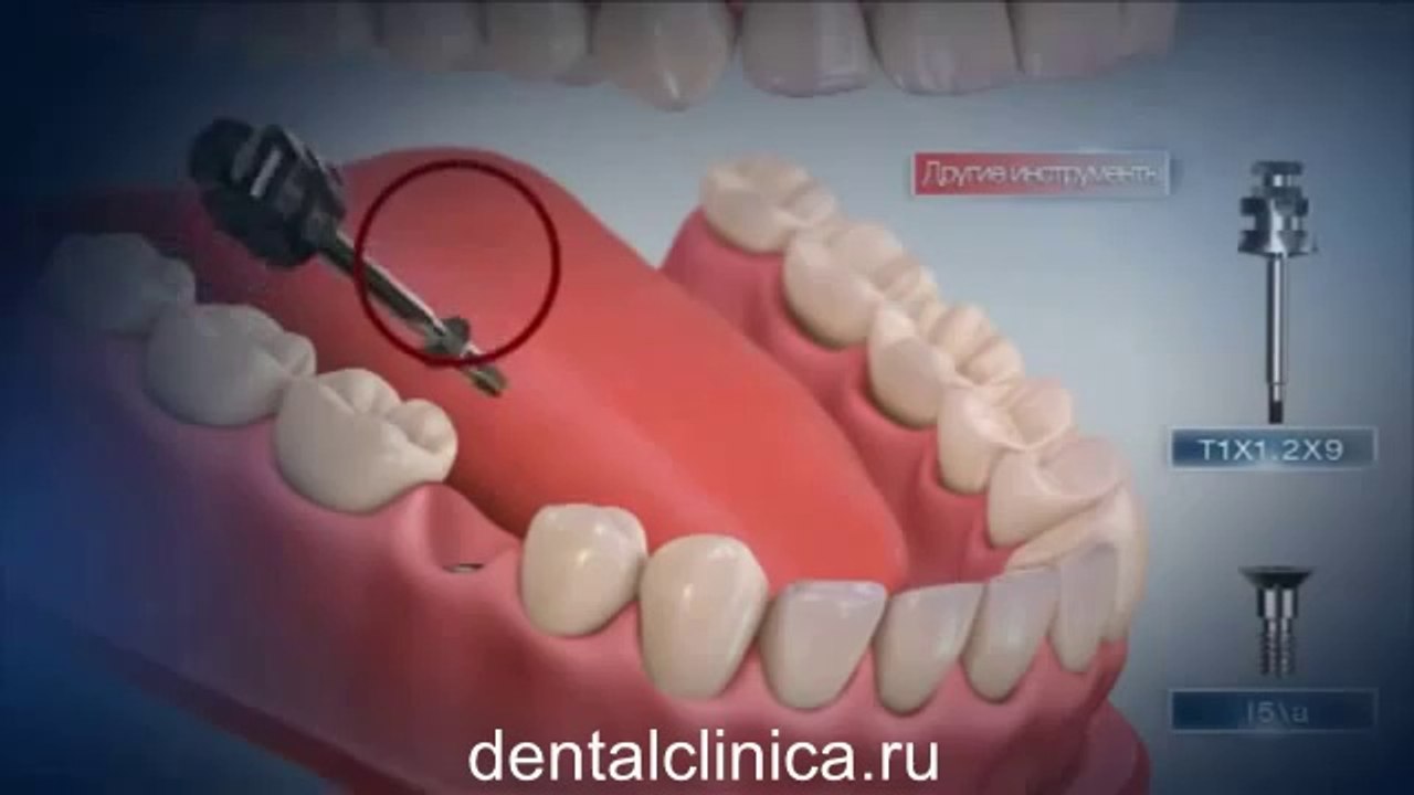 European Clinic of Aesthetic Dentistry Лечение зубов красивая улыбка коронки циркониевые металлокерамика приятные цены протезирование имплант СГС с абатмантом экспересс терапия