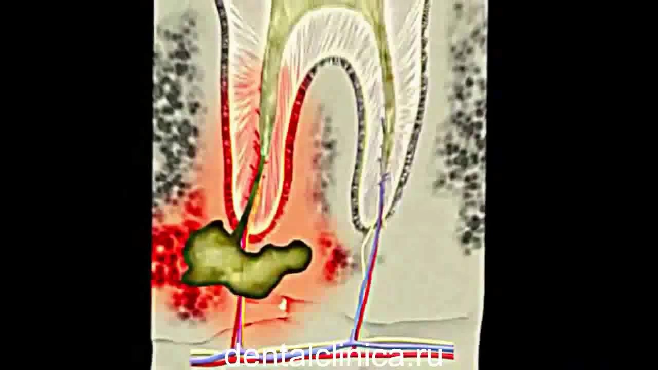 European Clinic of Aesthetic Dentistry Лечение зубов красивая улыбка коронки циркониевые металлокерамика приятные цены протезирование имплант СГС с абатмантом экспересс терапия
