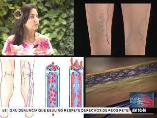 Entérese ¿Qué son las varices? y cómo eliminarlas