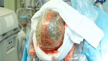 3D Printed Skull Implant Used to Save Woman's Life