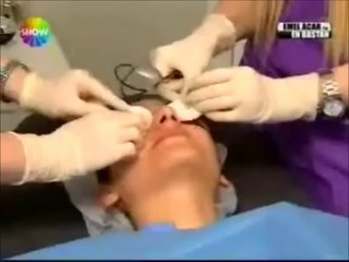 Lazer ile Leke Tedavisi