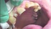 Mini Dental Implant for Replacement of Missing Tooth (Maxillary Lateral Incisor)