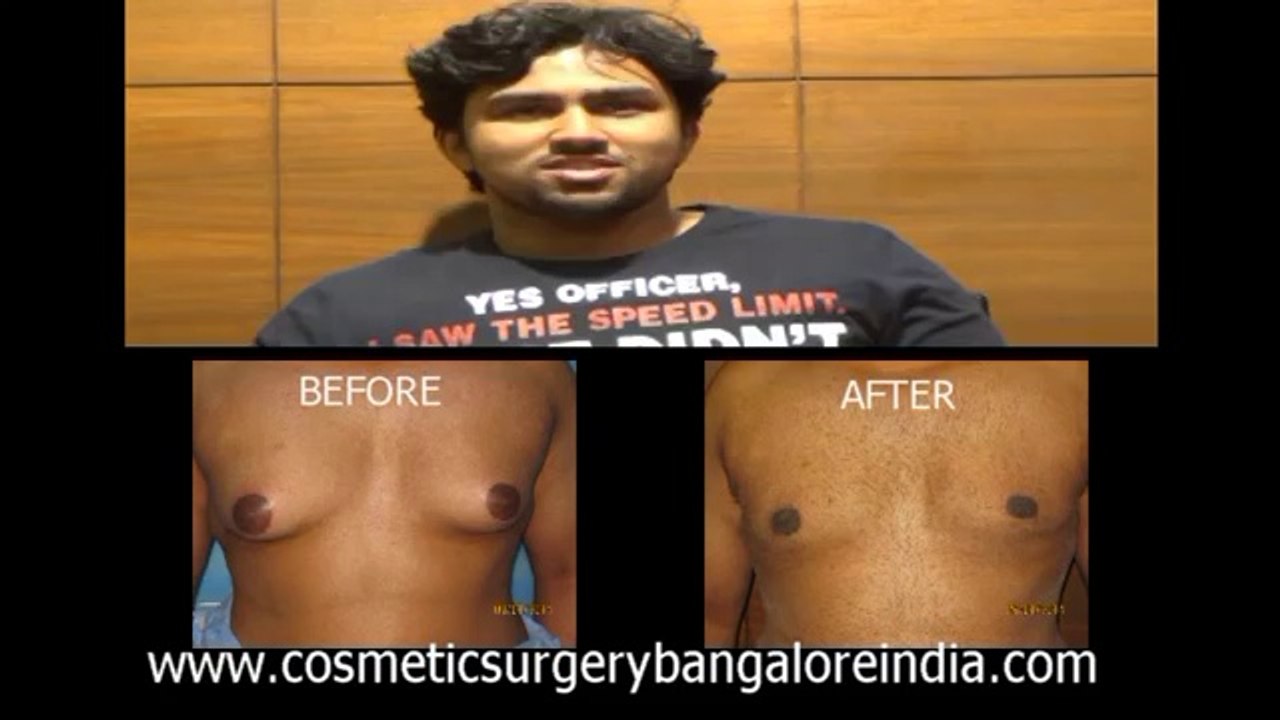 GYNECOMASTIA BANGALORE: Testimonial for Bangalore Doctor