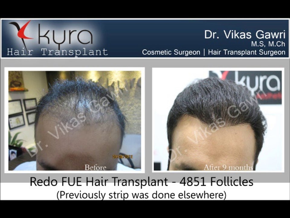 Hair transplant in Ludhiana, Punjab, India, Jalandhar, Amritsar