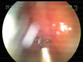 Kolon kanseri belirtileri nedir? Kolon kanseri öldürür mü? Kolon kanseri evreleri   Kolon kanseri olanların yorumlari