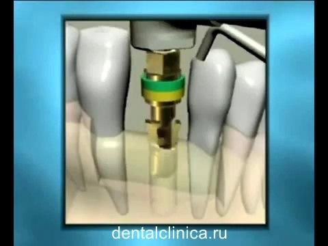 Стоматология лечение зубов в Санкт-Петербурге Москве European Clinic of Aesthetic Dentistry имплантация европейское качество низкие цены протезирование