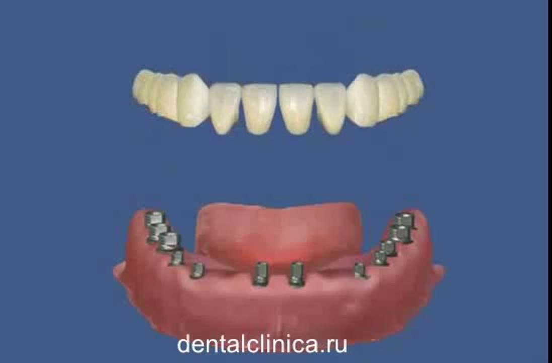 European Clinic of Aesthetic Dentistry Стоматология лечение зубов в Санкт-Петербурге Москве имплантация европейское качество низкие цены протезирование туризм путешествия отдых