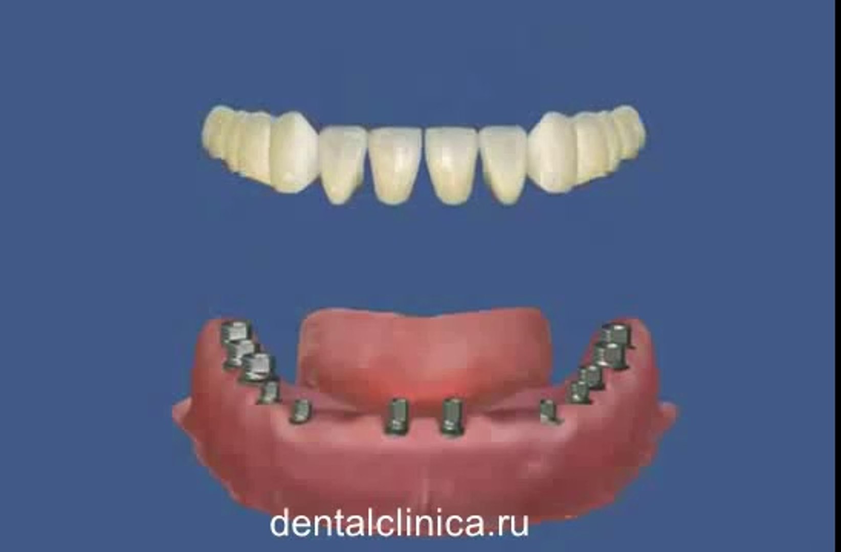 ⁣European Clinic of Aesthetic Dentistry Стоматология лечение зубов в Санкт-Петербурге Москве импланта